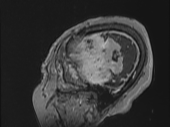 Atypical meningioma (Radiopaedia 62985-71406 Sagittal T1 C+ 90).jpg