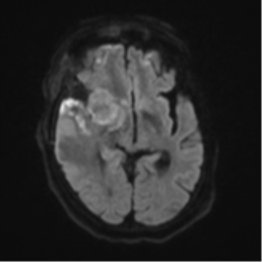 Atypical meningioma (WHO Grade II) (Radiopaedia 54742-60981 Axial DWI 41).png