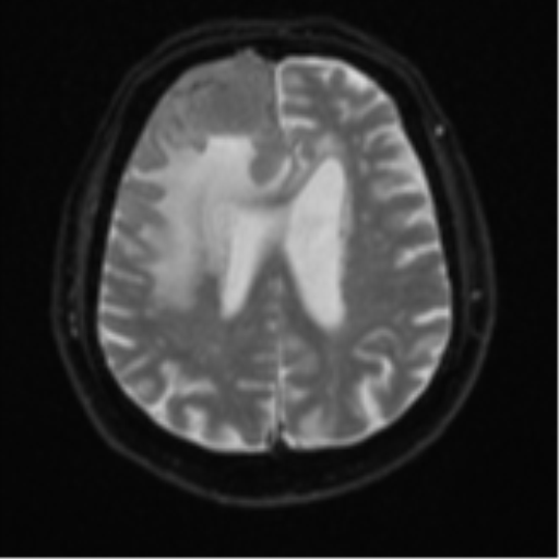 Atypical meningioma (WHO grade II) with brain invasion (Radiopaedia 57767-64729 Axial DWI 20).png