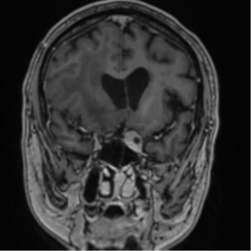 Atypical meningioma (WHO grade II) with brain invasion (Radiopaedia 57767-64729 Coronal T1 C+ 31).png