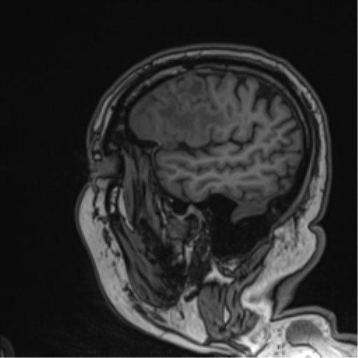 Atypical meningioma (WHO grade II) with brain invasion (Radiopaedia 57767-64729 Sagittal T1 53).png