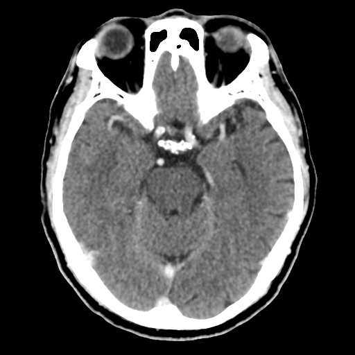 Atypical meningioma (WHO grade II) with osseous invasion (Radiopaedia 53654-59715 Axial C+ delayed 21).png