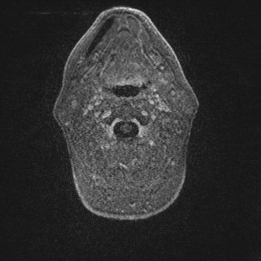 Atypical meningioma (grade II) - en plaque (Radiopaedia 29633-30147 Axial T1 C+ 2).jpg