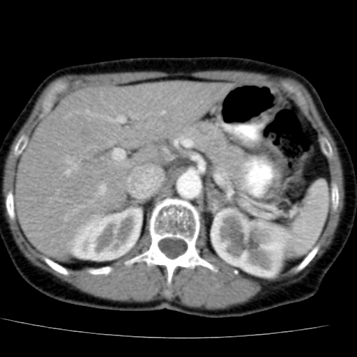 File:Atypical renal cyst (Radiopaedia 17536-17251 renal cortical phase 8).jpg