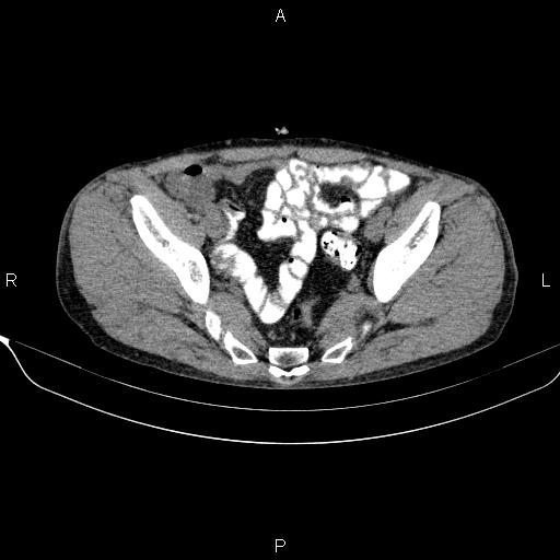 Autoimmune pancreatitis (Radiopaedia 84925-100431 Axial non-contrast 47).jpg