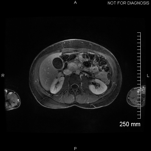Autoimmune pancreatitis (Radiopaedia 88443-105101 A 76).jpg