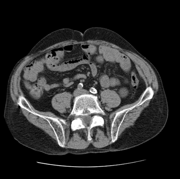 Autosomal dominant polycystic kidney disease (Radiopaedia 27851-28094 Axial non-contrast 88).jpg