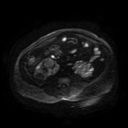 Autosomal dominant polycystic kidney disease (Radiopaedia 50259-55611 Axial DWI 103).jpg