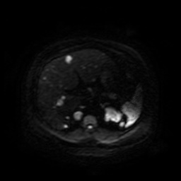Autosomal dominant polycystic kidney disease (Radiopaedia 50259-55611 Axial DWI 50).jpg