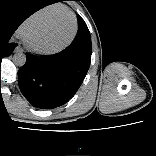 File:Avascular necrosis after fracture dislocations of the proximal humerus (Radiopaedia 88078-104653 D 112).jpg