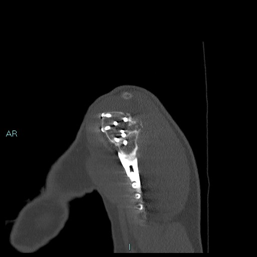 File:Avascular necrosis after fracture dislocations of the proximal humerus (Radiopaedia 88078-104655 Sagittal bone window 12).jpg