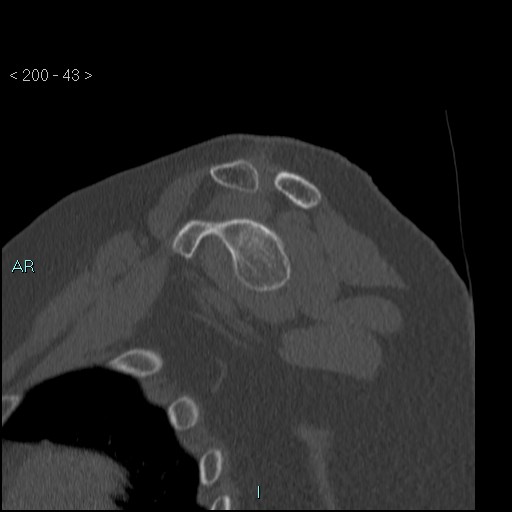 Avascular necrosis of the shoulder - Cruess stage I (Radiopaedia 77674-89887 Sagittal bone window 42).jpg