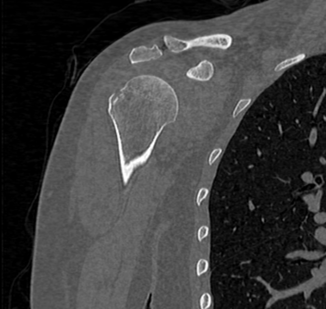 Avulsion fracture - greater tuberosity of humerus (Radiopaedia 71216-81514 Coronal bone window 21).jpg
