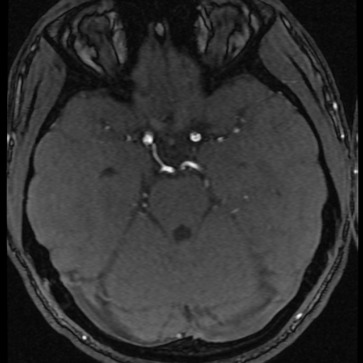 Azygos anterior cerebral artery (Radiopaedia 17059-16756 Axial MRA 48).jpg