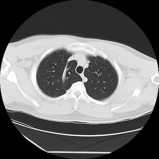 Azygos fissure (Radiopaedia 88181-104784 Axial lung window 9).jpg