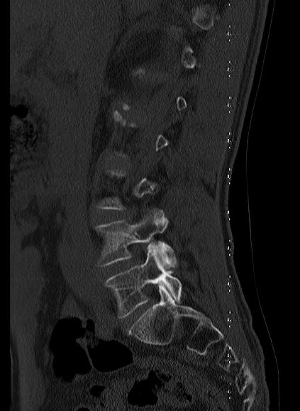 File:Baastrup syndrome (Radiopaedia 64891-73838 Sagittal bone window 2).jpg