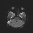 Balo concentric sclerosis (Radiopaedia 50458-55940 Axial DWI 39).jpg