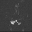 Balo concentric sclerosis (Radiopaedia 50458-55940 Axial DWI 67).jpg