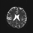 Balo concentric sclerosis (Radiopaedia 50458-55940 Axial DWI 9).jpg