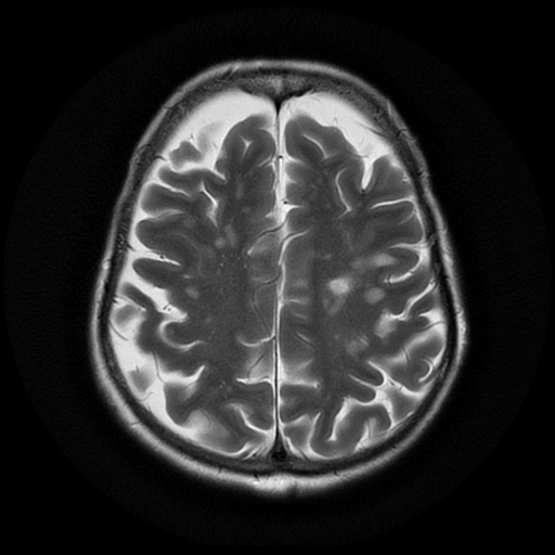 File:Balo concentric sclerosis (Radiopaedia 53875-59982 Axial T2 19).jpg