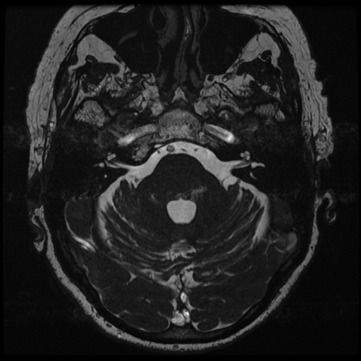 File:Balo concentric sclerosis (Radiopaedia 53875-59982 Axial T2 FIESTA 40).jpg