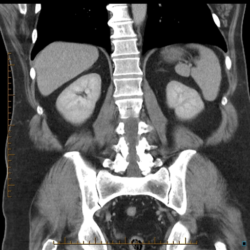 File:Bariatric balloon causing gastric outlet obstruction (Radiopaedia 54449-60672 B 43).jpg