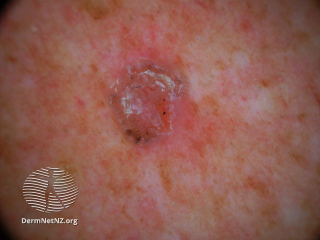 File:Basal cell carcinoma affecting the trunk (DermNet NZ lesions-bcc-trunk-0737).jpg