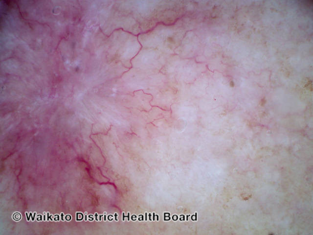 File:Basal cell carcinoma dermoscopy (DermNet NZ bcc-arm-8-wdhb).jpg