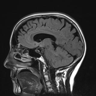 File:Base of skull chondrosarcoma (Radiopaedia 30410-31070 Sagittal FLAIR 10).jpg