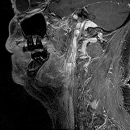 File:Base of tongue squamous cell carcinoma (Radiopaedia 31174-31884 F 122).jpg