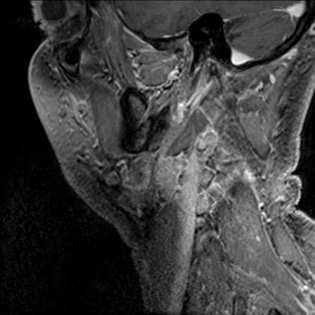 Base of tongue squamous cell carcinoma (Radiopaedia 31174-31884 F 141).jpg