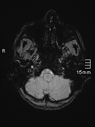 Basilar artery perforator aneurysm (Radiopaedia 82455-99523 Axial SWI 8).jpg