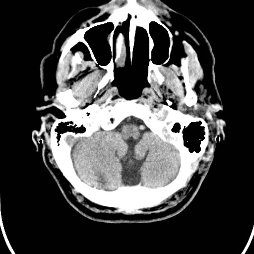 File:Basilar artery thrombosis (Radiopaedia 26986-27162 Axial non-contrast 5).jpg