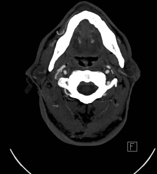 Basilar artery thrombosis (Radiopaedia 26986-27163 A 2).jpg