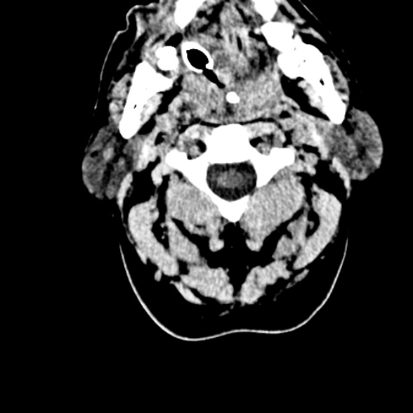 Basilar artery thrombosis (Radiopaedia 53351-59352 Axial non-contrast 4).jpg