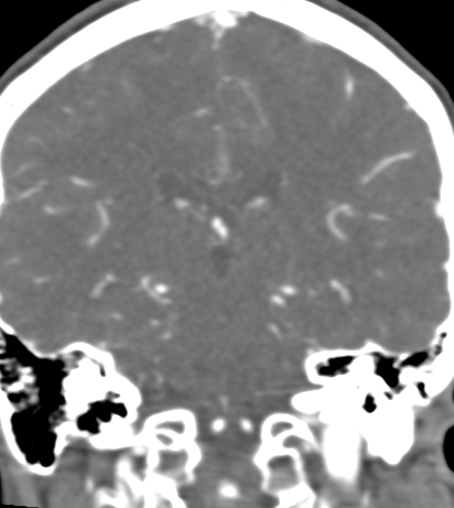 Basilar tip aneurysm with coiling (Radiopaedia 53912-60086 B 91).jpg