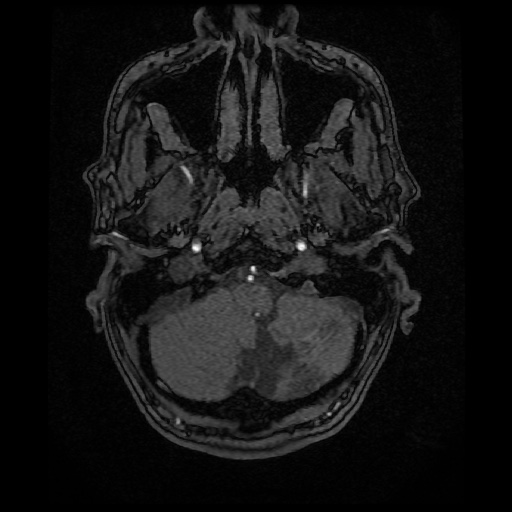 Basilar top and left middle cerebral artery aneurysm (Radiopaedia 61965-70031 Axial MRA 9).jpg