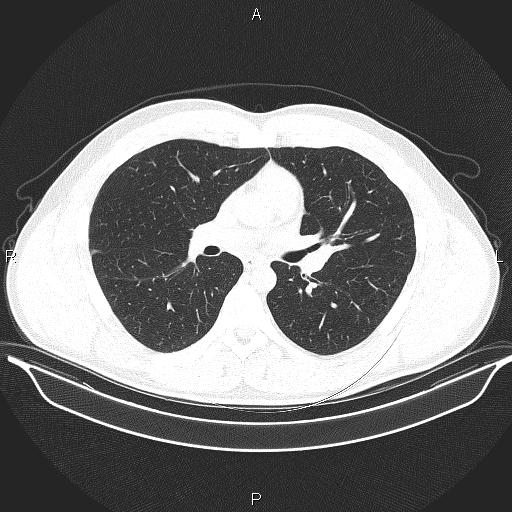 Beam hardening and ring artifacts (Radiopaedia 85323-100915 Axial lung window 37).jpg