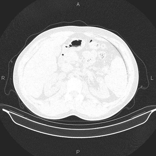 Beam hardening and ring artifacts (Radiopaedia 85323-100915 Axial lung window 80).jpg
