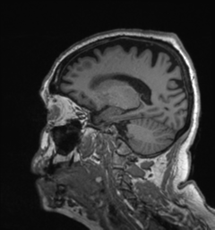 Behavioral variant frontotemporal dementia and late onset schizophrenia (Radiopaedia 52197-58083 Sagittal T1 67).png