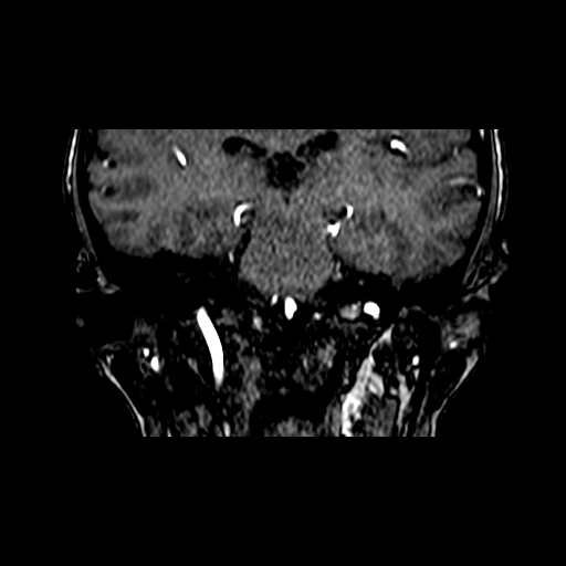 File:Berry aneurysm of the terminal internal carotid artery (Radiopaedia 88286-104918 Coronal TOF 60).jpg