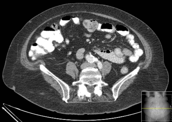 Bicameral celiacomesenteric aneurysm (Radiopaedia 55766-62327 A 42).jpg