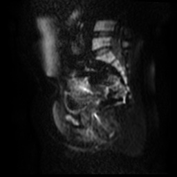 File:Bicornuate uterus (Radiopaedia 51676-57472 Sagittal DWI 39).jpg