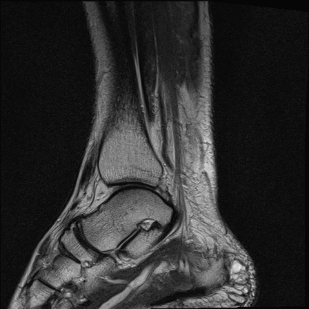File:Bilateral Achilles tendon complete tear (Radiopaedia 81344-95051 Sagittal T2 12).jpg