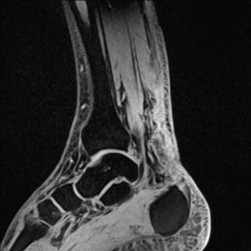 Bilateral Achilles tendon complete tear (Radiopaedia 81344-95051 Sagittal WE - Left 47).jpg