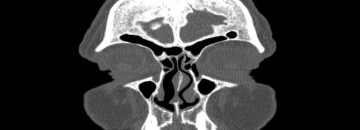 Bilateral Ectopic Infraorbital Nerves (Radiopaedia 49006-54084 Coronal bone window 4).jpg