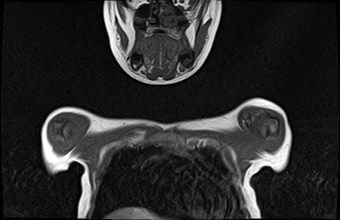 File:Bilateral Sprengel deformity with Klippel-Feil syndrome (Radiopaedia 66395-75650 Coronal T1 3).jpg