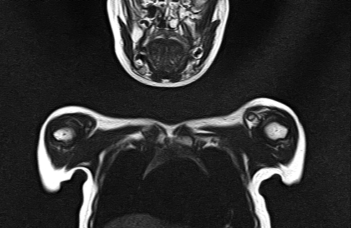 File:Bilateral Sprengel deformity with Klippel-Feil syndrome (Radiopaedia 66395-75650 Coronal T2 4).jpg