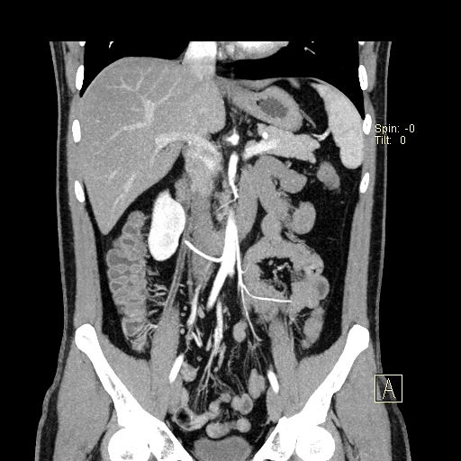 File:Bilateral accessory renal arteries with mild pelvi-ureteric junction (PUJ) obstruction (Radiopaedia 66357-75596 B 13).jpg