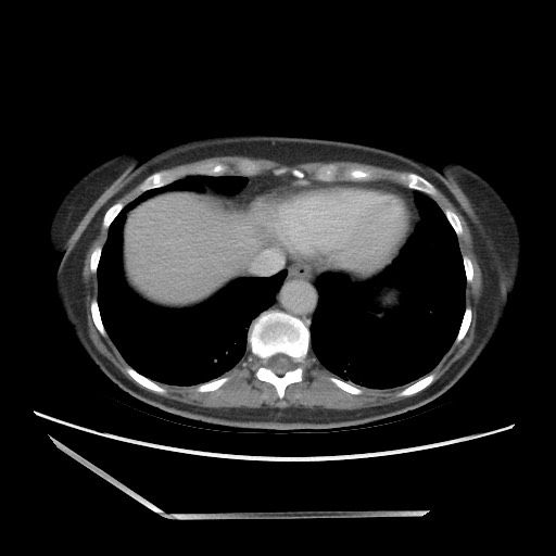 Bilateral adrenal granulocytic sarcomas (chloromas) (Radiopaedia 78375-91007 A 15).jpg
